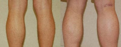 Calf Implants Before & After Gallery - Patient 429171 - Image 1