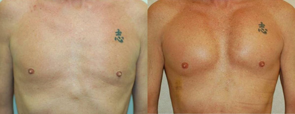 Pectoral Implants Before & After Gallery - Patient 281877 - Image 1