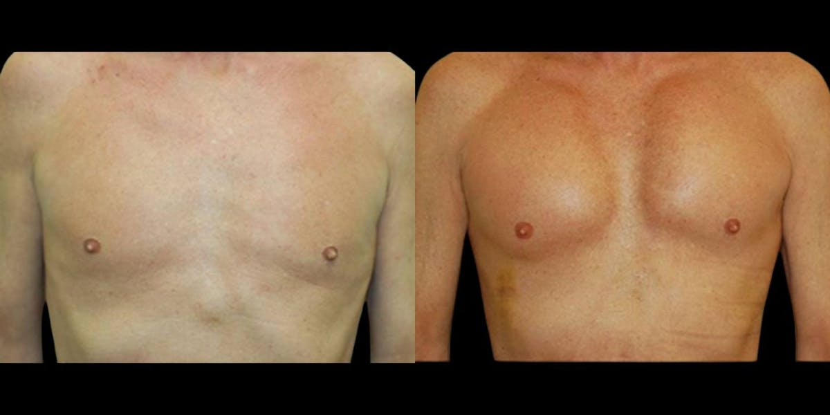 Pectoral Implants Before & After Gallery - Patient 114412 - Image 1