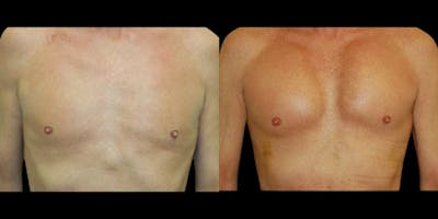 Pectoral Implants Before & After Gallery - Patient 114412 - Image 1