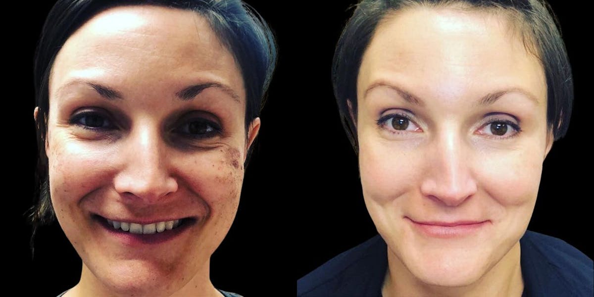 IPL (Intense Pulse Light) Before & After Gallery - Patient 167023 - Image 1