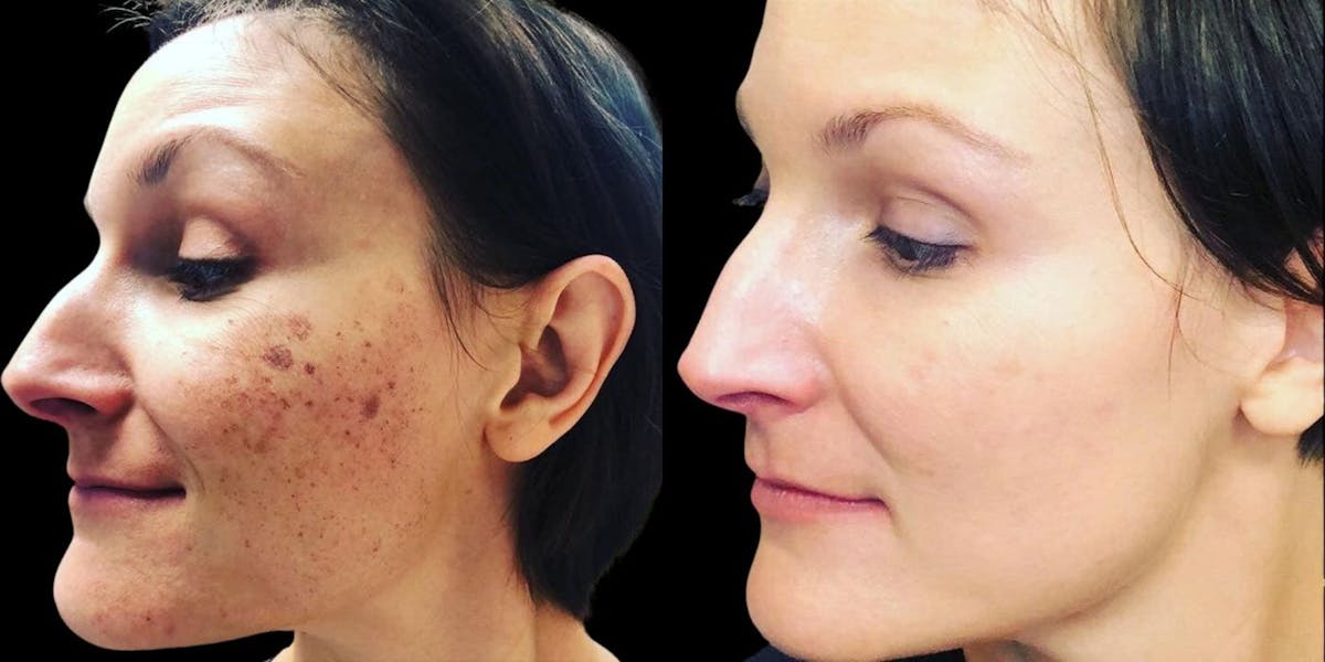 IPL (Intense Pulse Light) Before & After Gallery - Patient 754327 - Image 1