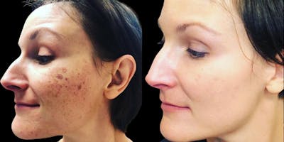 IPL (Intense Pulse Light) Before & After Gallery - Patient 754327 - Image 1