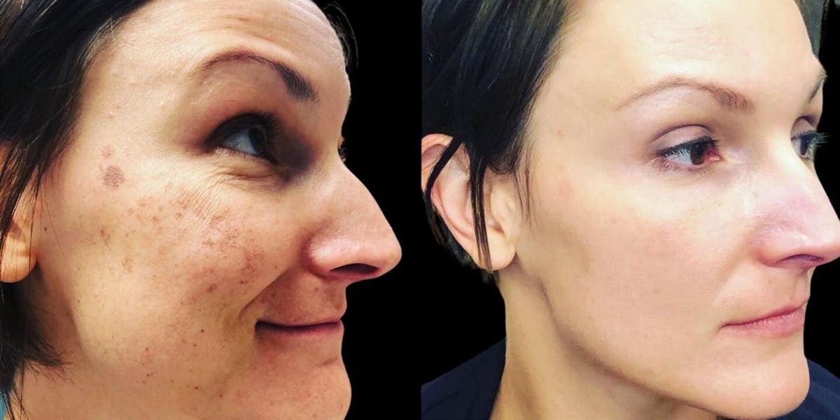 IPL (Intense Pulse Light) Before & After Gallery - Patient 266115 - Image 1