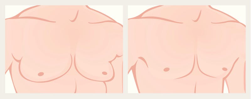 Gynecomastia Surgery illustration