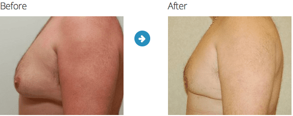 male chest reduction
