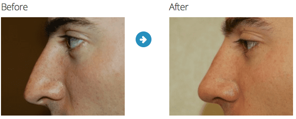 male nose job
