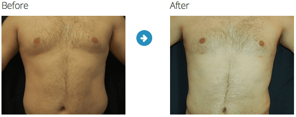 mens liposuction