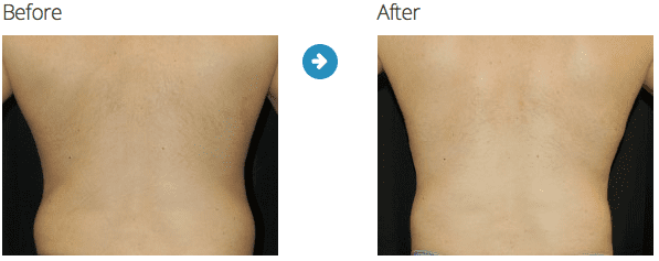 mens liposuction