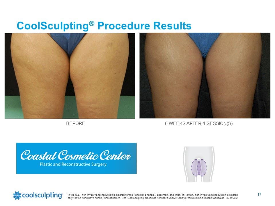 Coolsculpting before and after