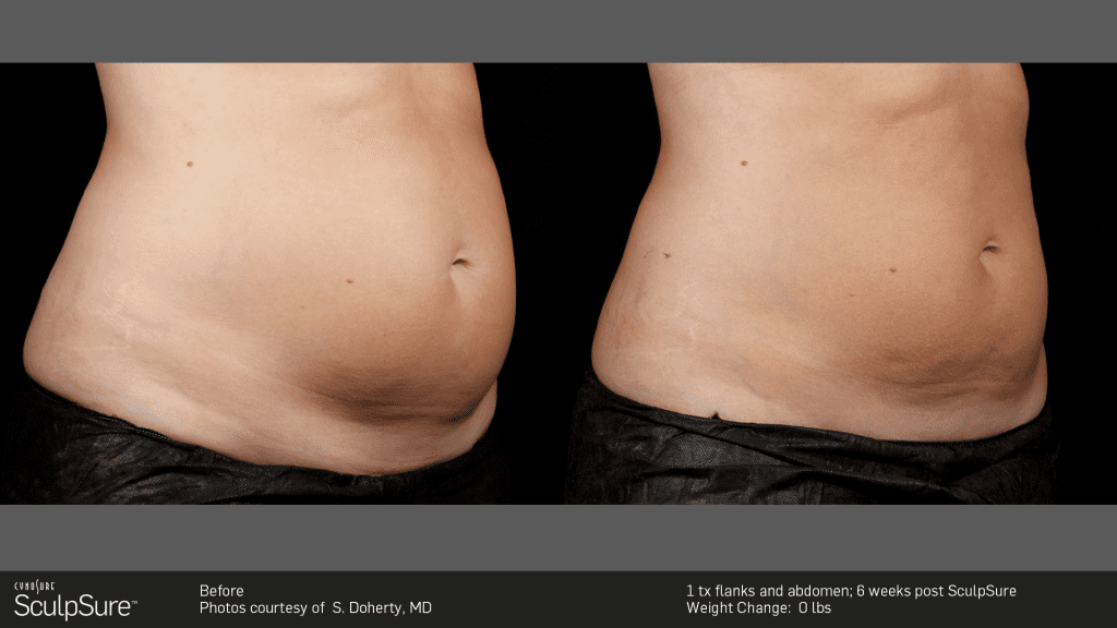 coolsculpting results