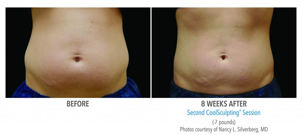 coolsculpting results