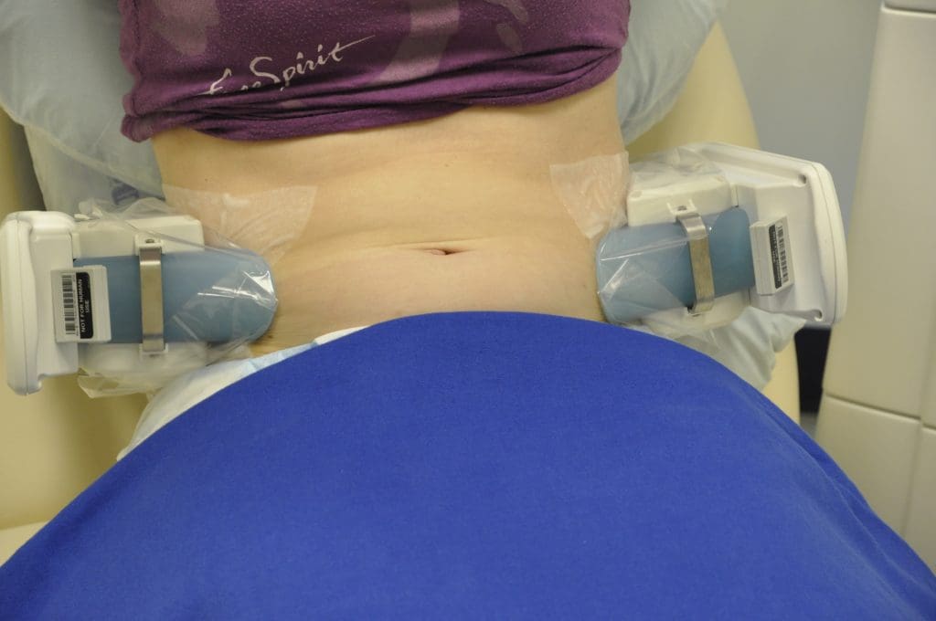 coolsculpting procedure