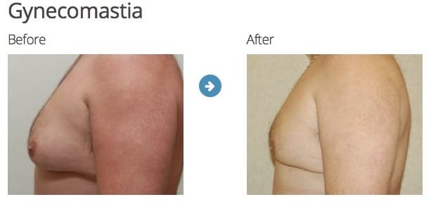 gynecomastia results
