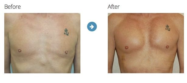 gynecomastia results