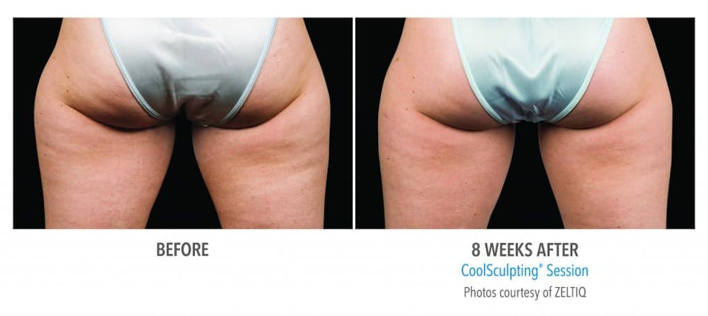 CoolSculpting&reg; in Jacksonville & Fleming Island, FL