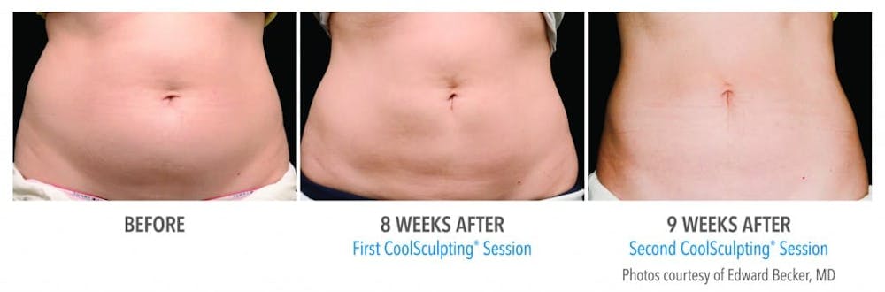 CoolSculpting® in Jacksonville & Fleming Island, FL