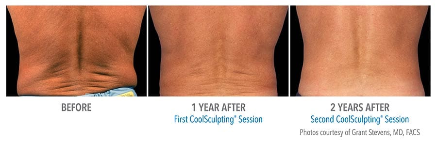Coolsculpting before and after
