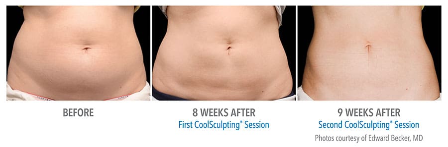 coolsculpting before and after images