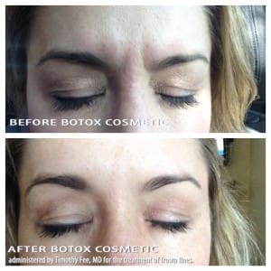 botox results
