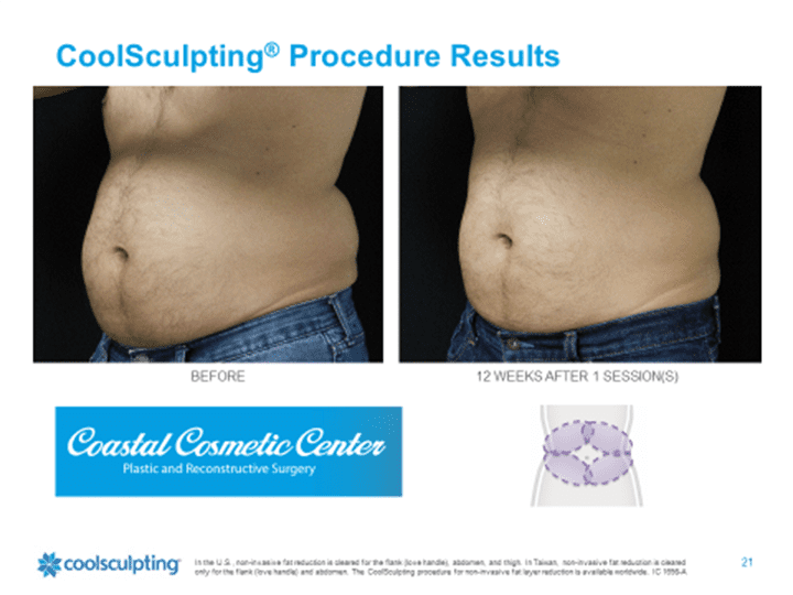 coolsculpting results