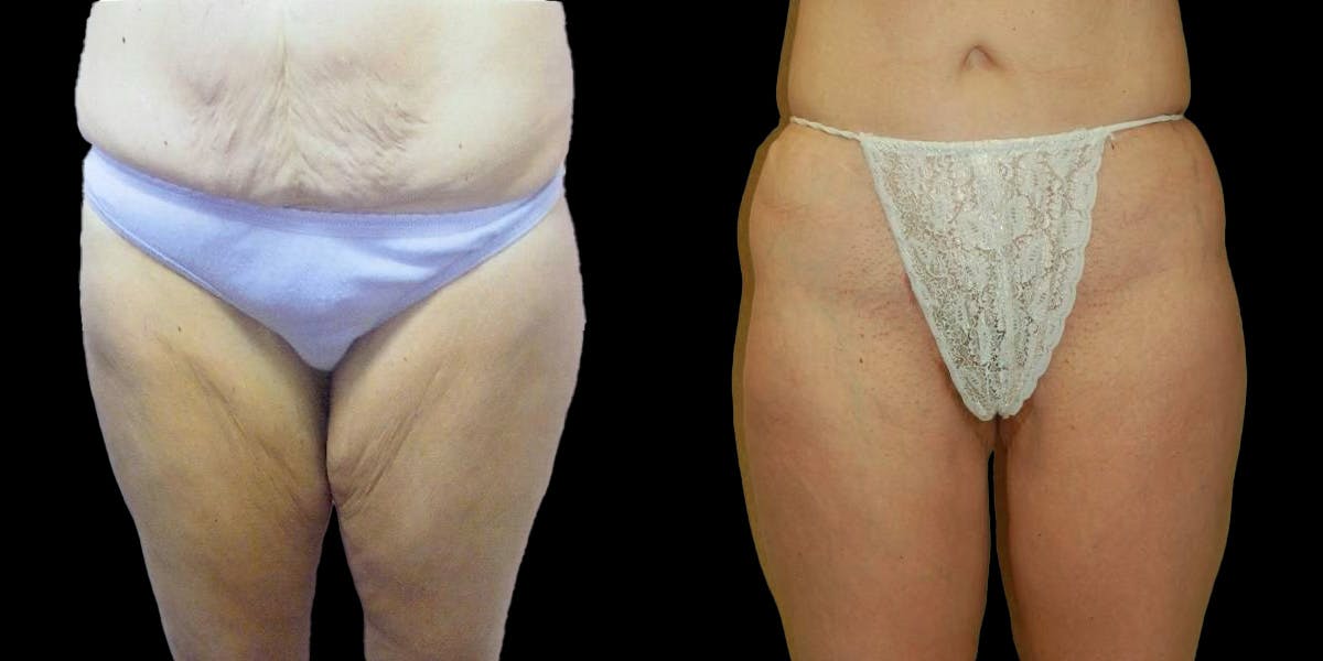Thigh Lift Before & After Gallery - Patient 281882 - Image 1