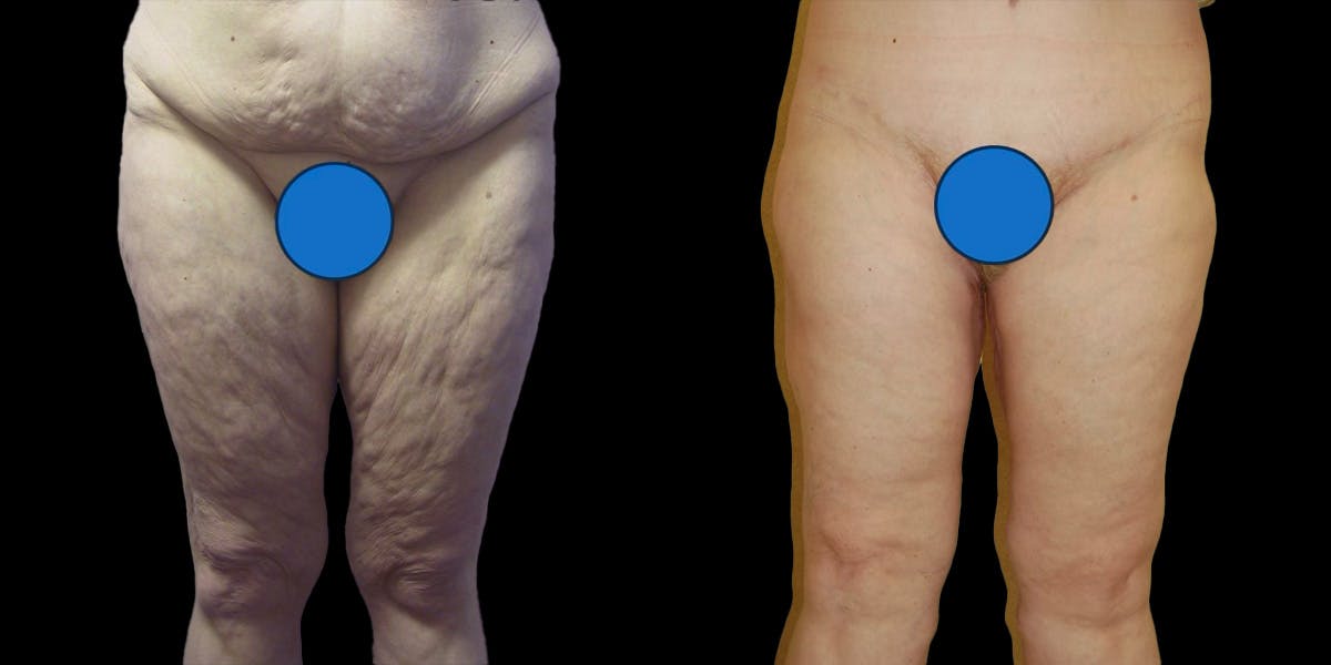 Thigh Lift Before & After Gallery - Patient 151831 - Image 1