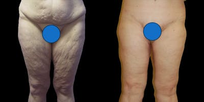 Thigh Lift Before & After Gallery - Patient 151831 - Image 1