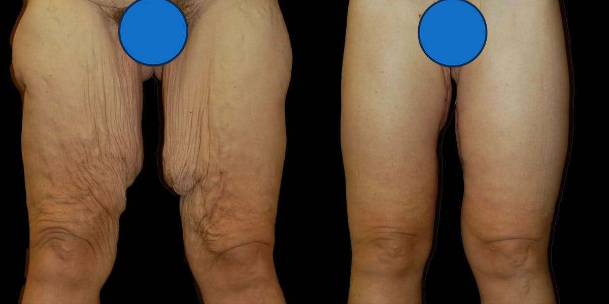 Thigh Lift Before & After Gallery - Patient 113875 - Image 1