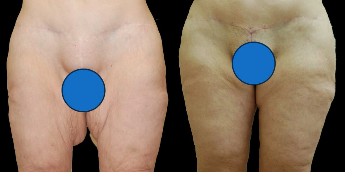 Thigh Lift Before & After Gallery - Patient 271599 - Image 1