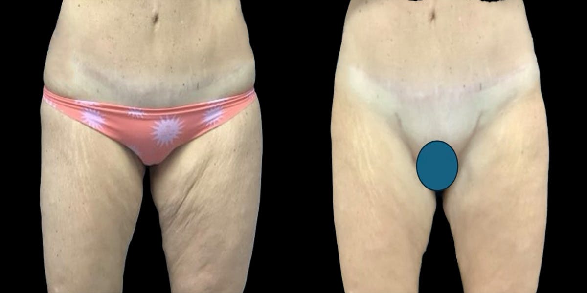Thigh Lift Before & After Gallery - Patient 311757 - Image 1