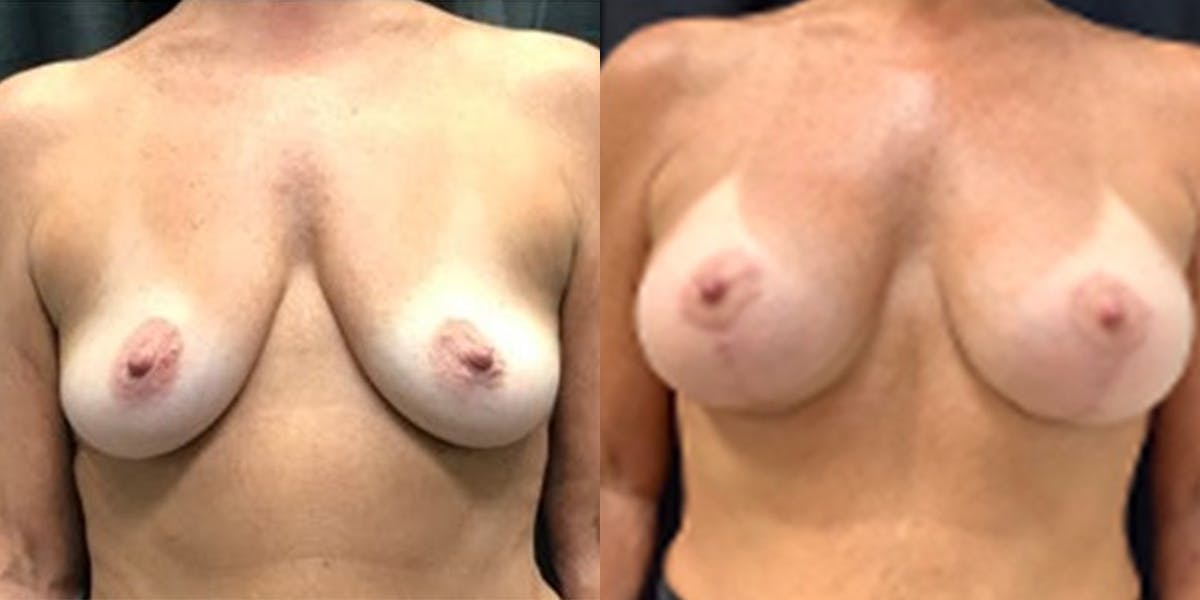 Breast Augmentation with Lift Before & After Gallery - Patient 305924 - Image 1