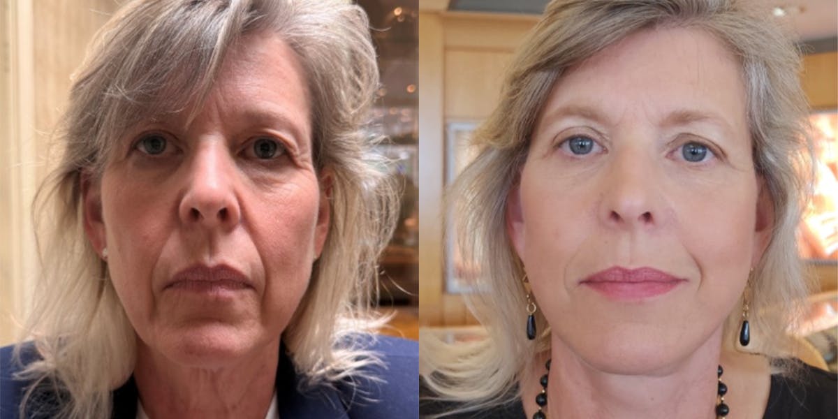 Blepharoplasty Before & After Gallery - Patient 111485 - Image 1