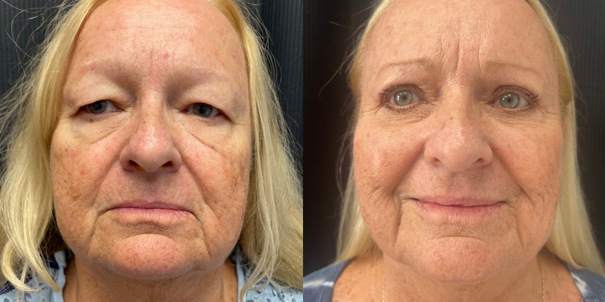 Blepharoplasty Before & After Gallery - Patient 303676 - Image 1