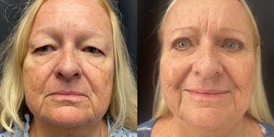 Blepharoplasty Before & After Gallery - Patient 303676 - Image 1