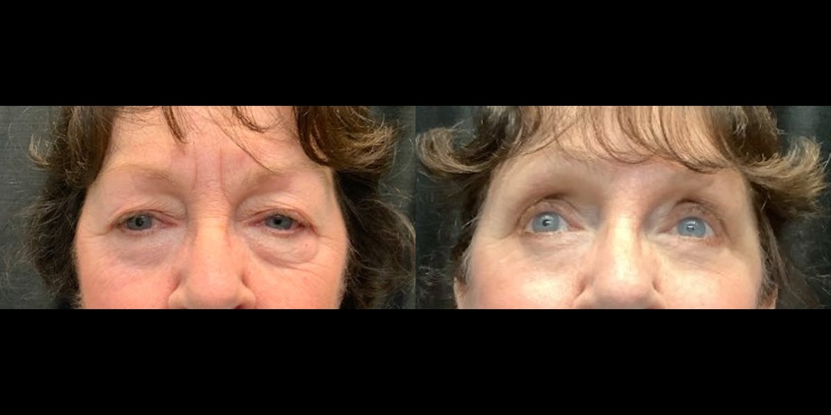 Blepharoplasty Before & After Gallery - Patient 411340 - Image 1