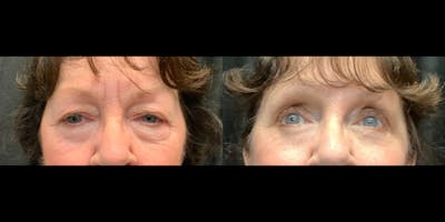 Blepharoplasty Before & After Gallery - Patient 411340 - Image 1