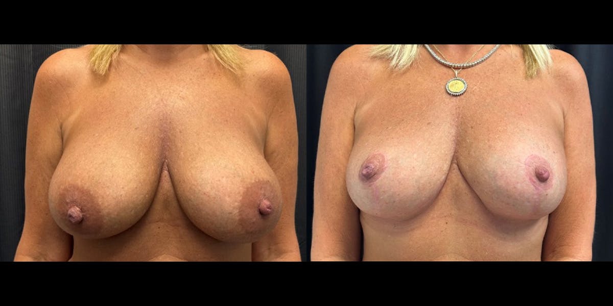 Breast Augmentation with Lift Before & After Gallery - Patient 375633 - Image 1