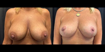 Breast Augmentation with Lift Before & After Gallery - Patient 375633 - Image 1