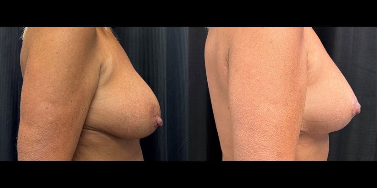 Breast Augmentation with Lift Before & After Gallery - Patient 375633 - Image 2
