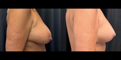 Breast Augmentation with Lift Before & After Gallery - Patient 375633 - Image 2