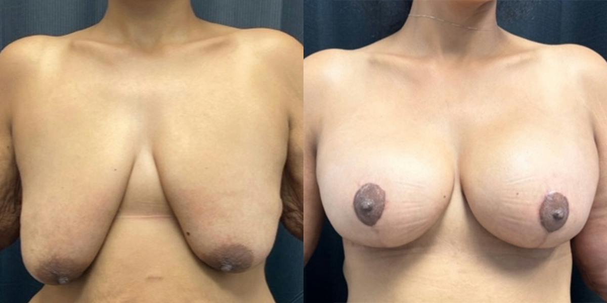 Breast Augmentation with Lift Before & After Gallery - Patient 916219 - Image 1