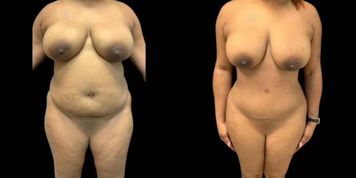 Tummy Tuck Before & After Gallery - Patient 356974 - Image 1