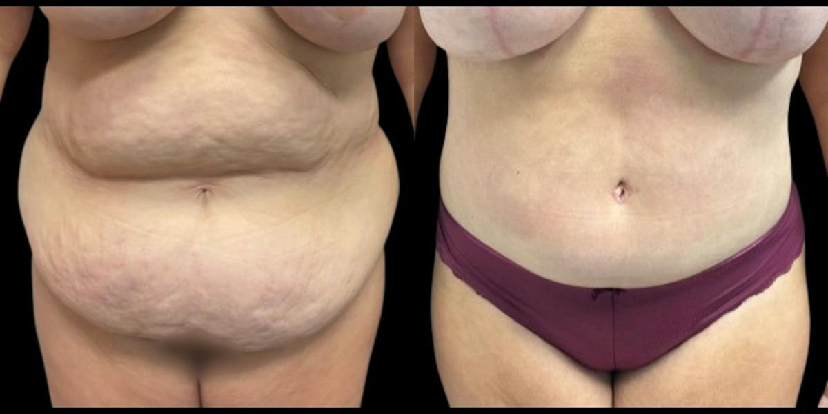 Tummy Tuck Before & After Gallery - Patient 299198 - Image 1