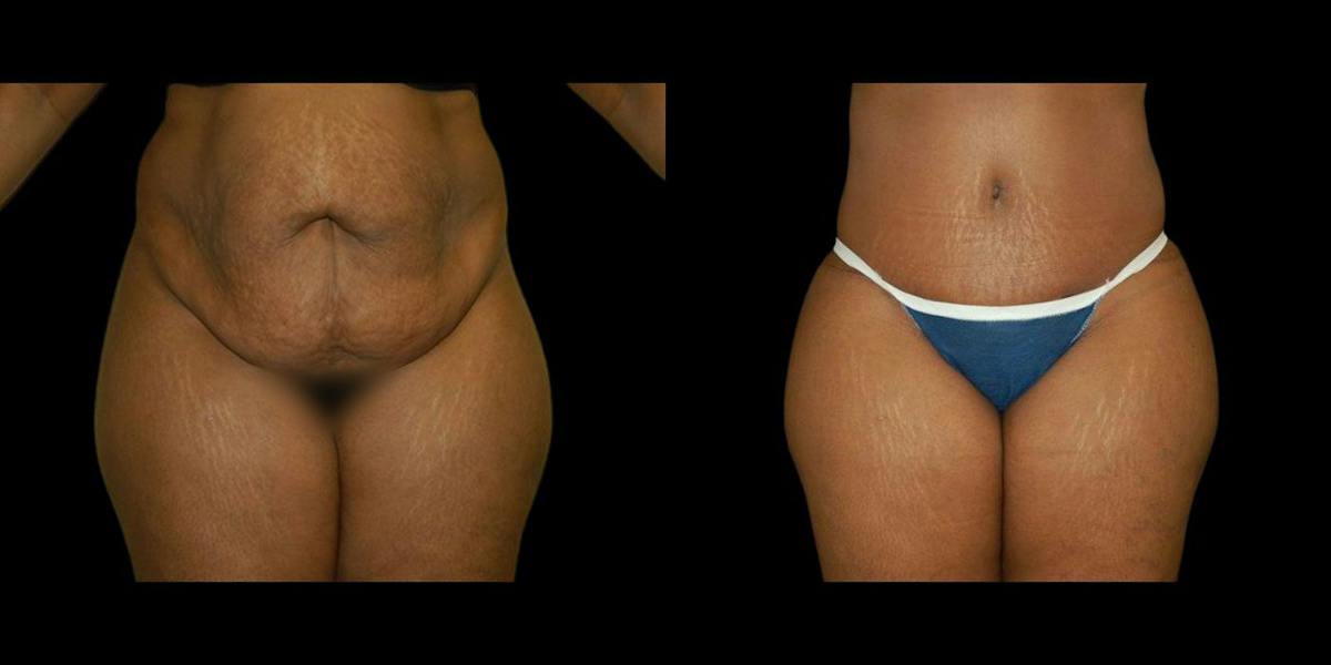 Tummy Tuck Before & After Gallery - Patient 116548 - Image 1