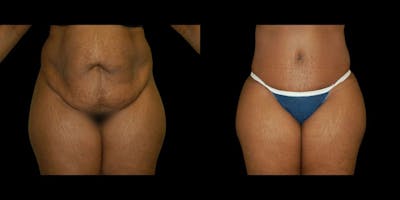 Tummy Tuck Before & After Gallery - Patient 116548 - Image 1