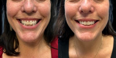 Neurotoxins Before & After Gallery - Patient 206325 - Image 1