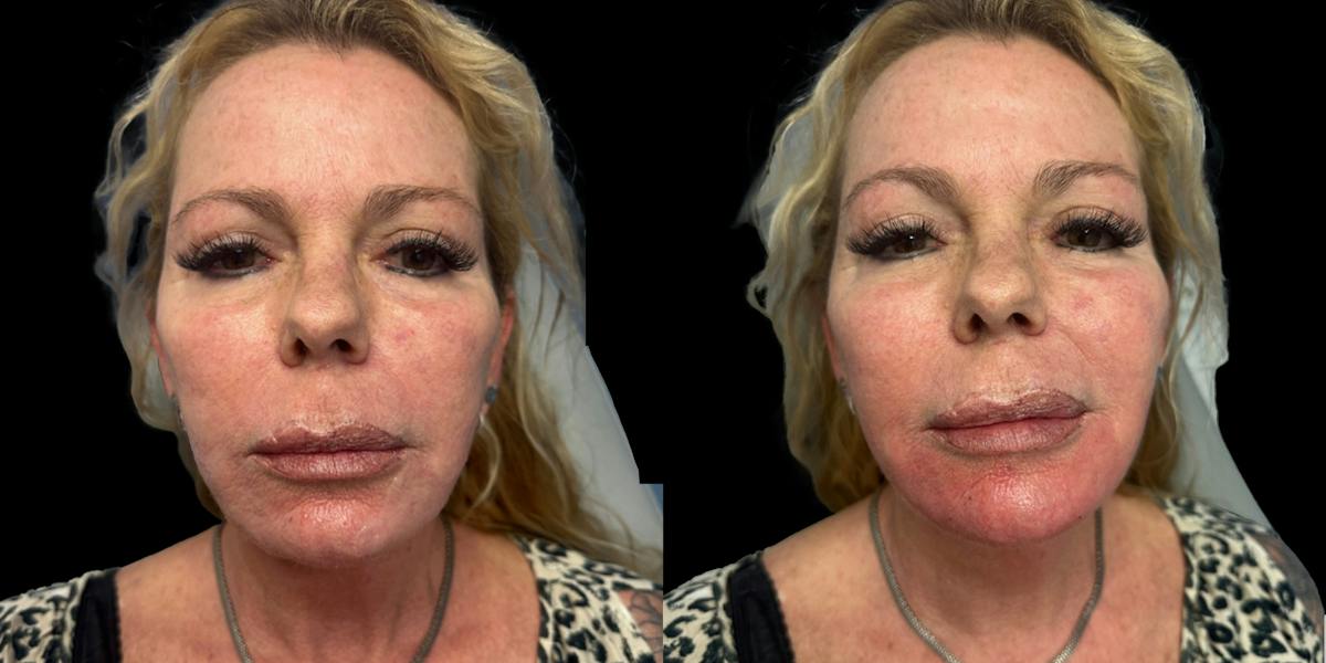 Fillers Before & After Gallery - Patient 995856 - Image 1