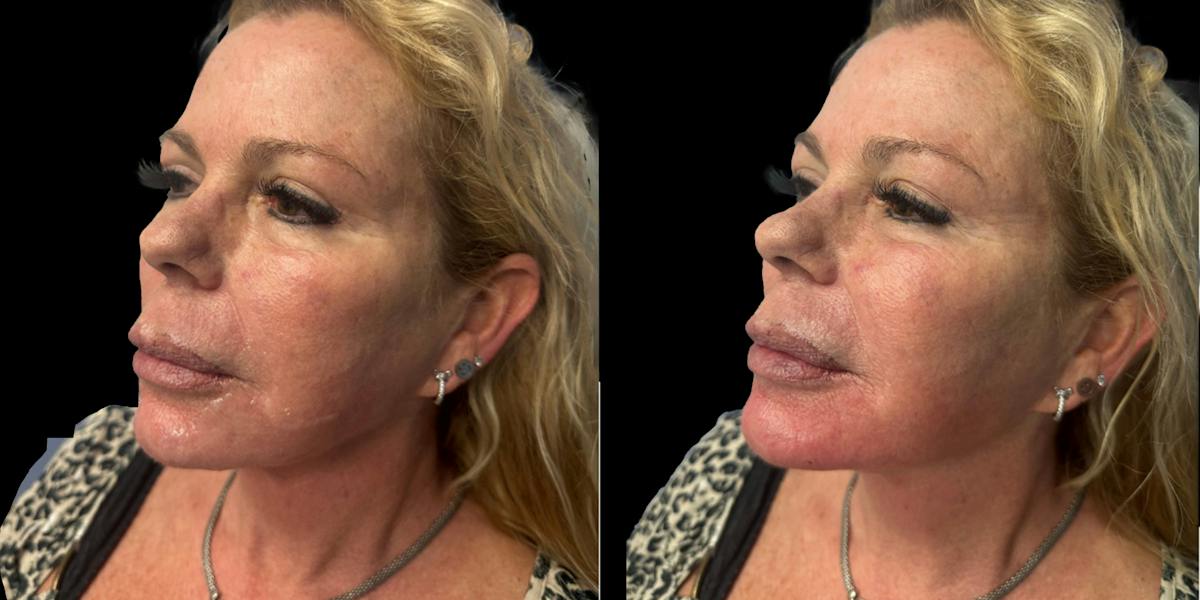 Fillers Before & After Gallery - Patient 995856 - Image 2