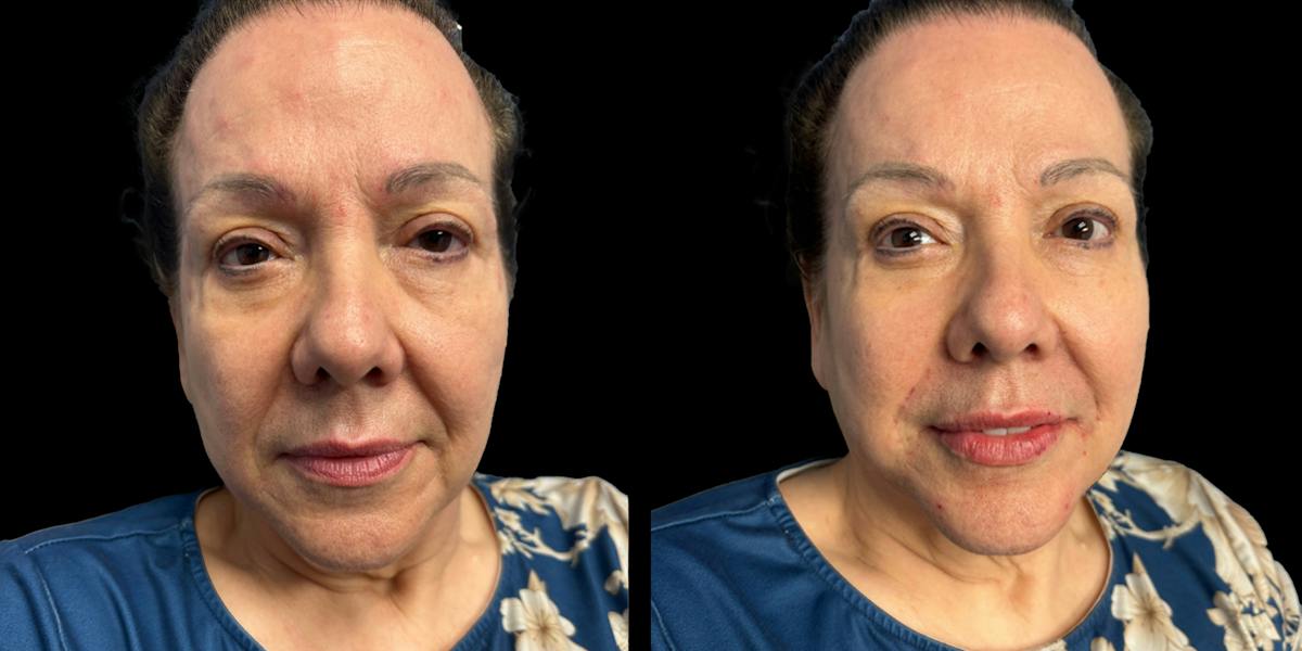 Fillers Before & After Gallery - Patient 303414 - Image 1